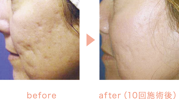 before/after（10回施術後）