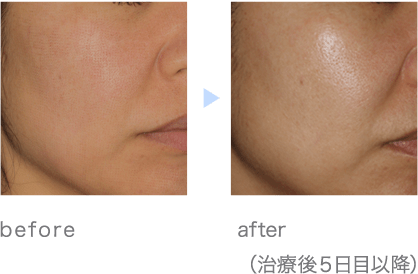 before/after（治療後５日目以降）