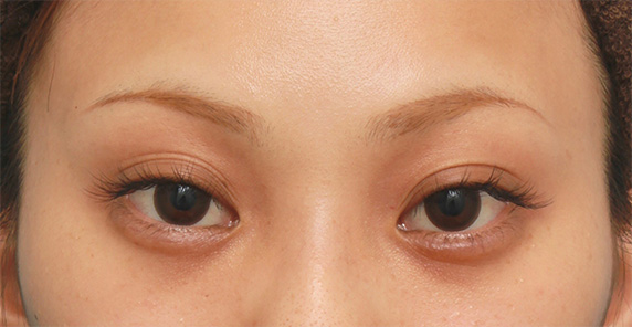 症例写真,キツいつり目にヒアルロン酸注射で涙袋を作り、優しい印象の目にした症例写真の術前術後,After（3ヶ月後）,ba_namida17_b.jpg