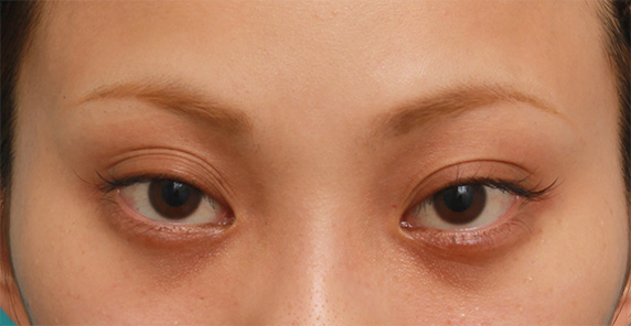 症例写真,キツいつり目にヒアルロン酸注射で涙袋を作り、優しい印象の目にした症例写真の術前術後,Before,ba_namida17_b.jpg