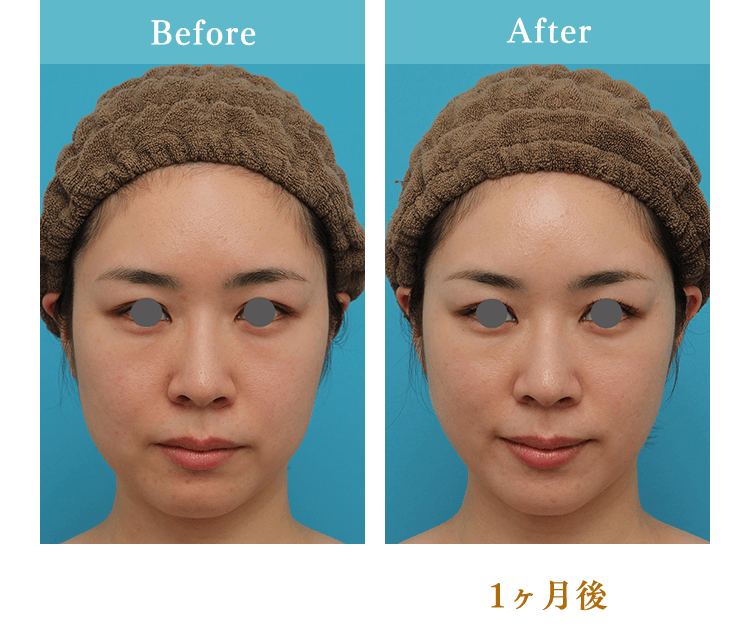 Before/After(1ヶ月後)